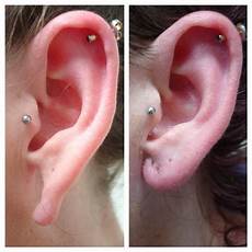 Skin Stretcher